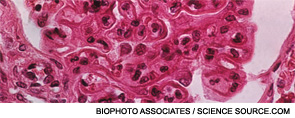 The pattern of lupus glomerular involvement in lupus is similar to that in membranous nephropathy, forming wire-loops lesions. 