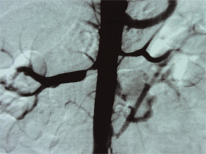 Renal artery stenosis in a patient with APS