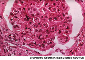 Lupus Nephropathy. The pattern of lupus glomerular involvement is similar to that in membranous nephropathy, forming wire-loops lesions.