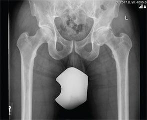 Preoperative X-ray Anterior-posterior pelvic radiograph showing remarkable degradation and decreased joint space of the left hip.
