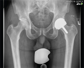 Postoperative X-ray Anterior-posterior pelvic radiograph showing left hip resurfacing.