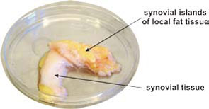 Figure 3: Example of fat tissue in close proximity to synovial tissue.