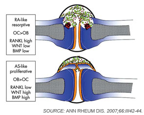 Figure 2: Joint remodelling in arthritis.