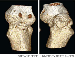 Figure 3: Three-dimensional reconstruction of a metacarpophalangeal joint of an RA patient.