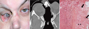 Figure 1: Destructive lesions in WG.