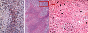 Figure 2: WG in respiratory tract (sinonasal mucosa).