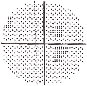 Figure 2: Automated visual field.