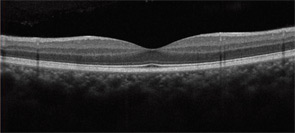 Figure 3: SD-OCT cross-sectional images of the retina.