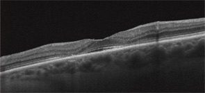 B: Eye with well-developed HCQ toxicity. There is marked thinning of the retina just outside the fovea (making the bull’s eye). Central vision will be preserved until the ring widens to close off the center. Damage can be recognized at an earlier stage.