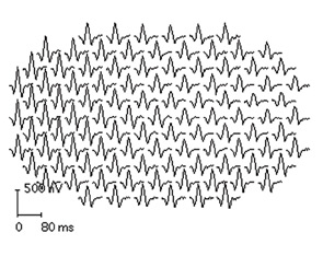 Figure 4: mfERG showing a set of electrical responses to light topographically across the macula.