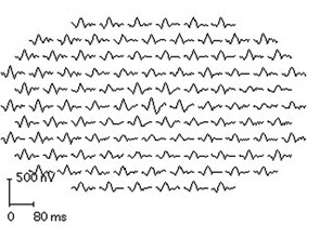 B: Eye with early HCQ toxicity. The parafoveal responses are smaller than those in either the center or periphery.