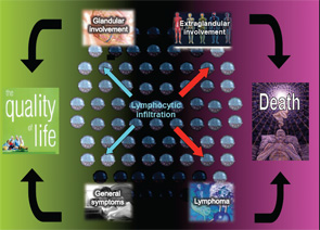 Figure 1: The spectrum of primary Sjögren’s syndrome extending from sicca syndrome and general features to systemic Sjögren’s and B-cell lymphoma.