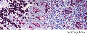 Small intestine and lymph node biopsies showing evidence of Whipple’s disease.