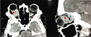 Axial (left panel) and sagittal reformat (right panel) contrast enhanced CT scan of the orbit showing tumefactive mildly enhanced perineural soft tissue density encasing right optic nerve, involving retroconal space (red circle) and extending to lateral and superior recti muscles (blue circle) consistent with orbital pseudotumour. Another left side perineural small nodule is also seen (arrow).