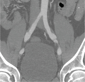 Common Iliac Artery Dissections