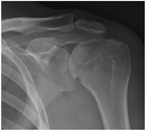 Figure 1: Left shoulder anteroposterior radiograph