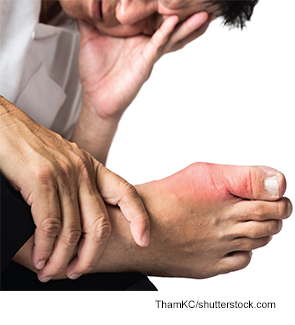 Changes in gout