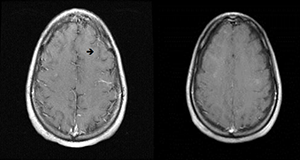 Figure 5: Left: MRI imaging shows the T1 postcontrast image demonstrating the cord lesion in the<br /><br /><br />
left frontal lobe in December 2010. Right: On repeat imaging in July 2011, the enhancement is mostly resolved.